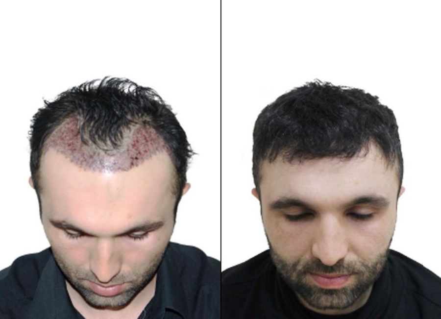 Клиника по пересадке волос